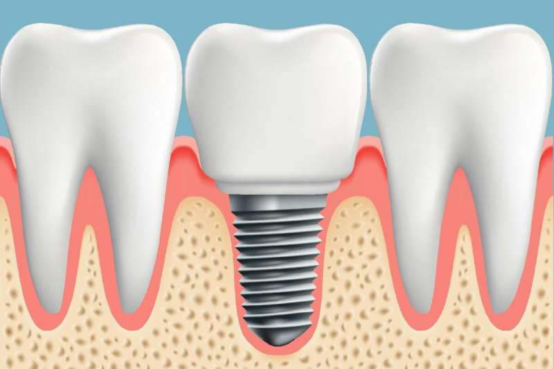 Un implante dental. /EPDA